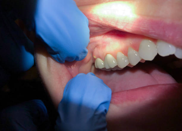 Best Emergency Dental Filling Replacement  in Painesville, OH